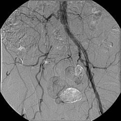 Verschluss der Beckenschlagader rechts