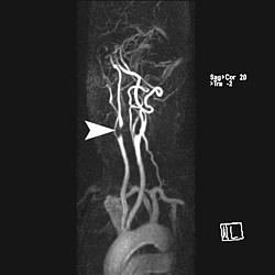 Hochgradige Stenose (Enge) der rechten Halsschlagader